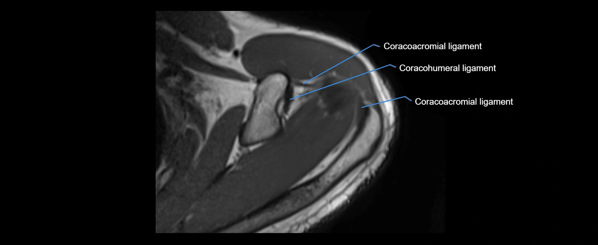 shoulder ligaments axial 3d 3t mri image-img-00005-00038.webp